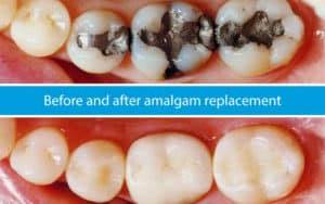 Before and After Amalgam