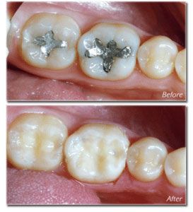 Before and After Amalgam