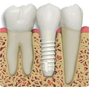 Ceramic Implants