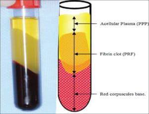 Platelet Rich Fibrin