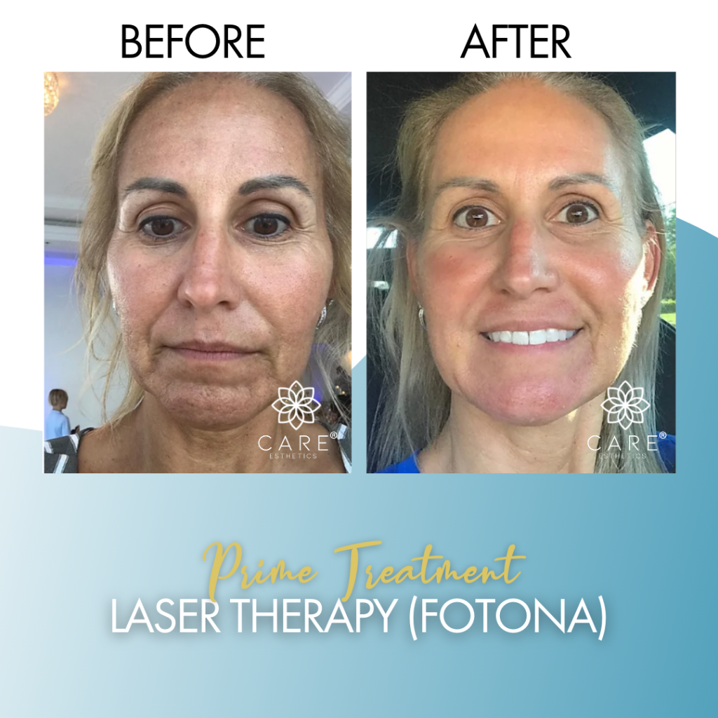 Fotona laser deals